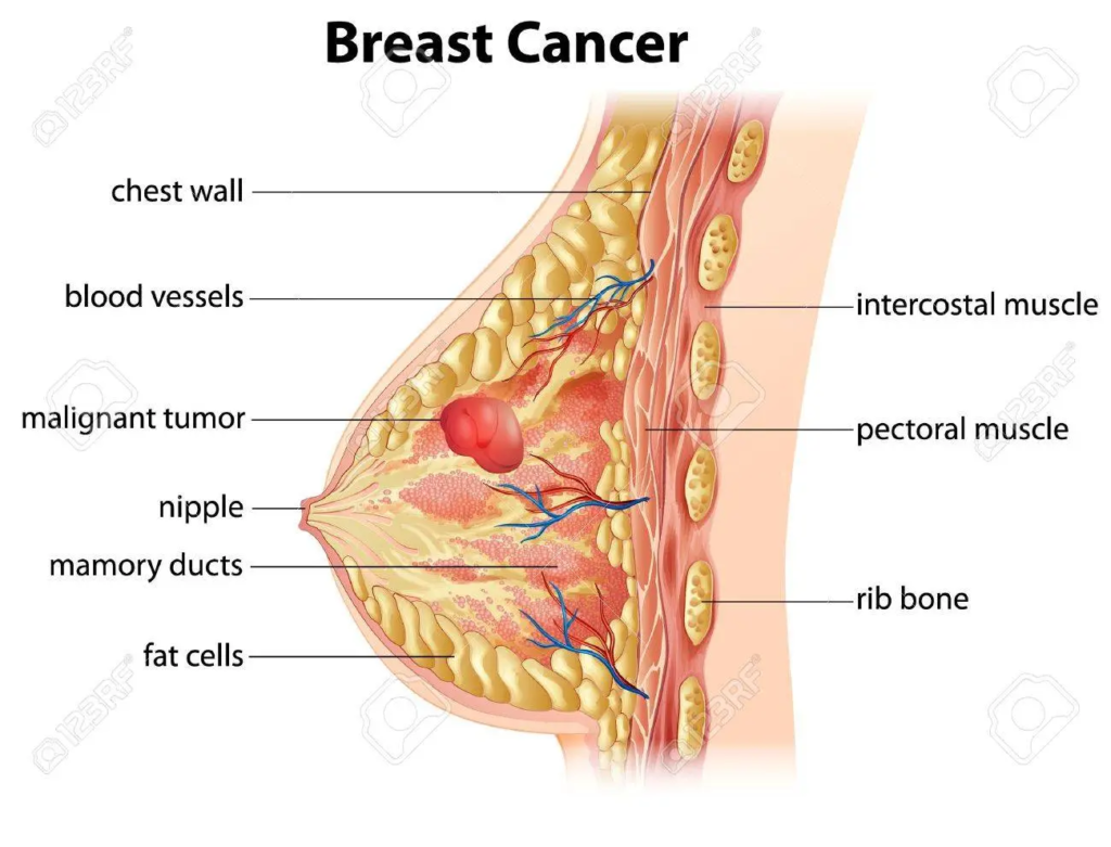 Breast Cancer