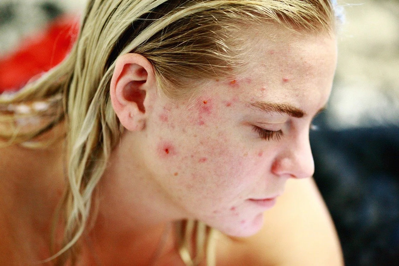  Pregnancy Acne: What is the Reason and How to Treat It Safely?