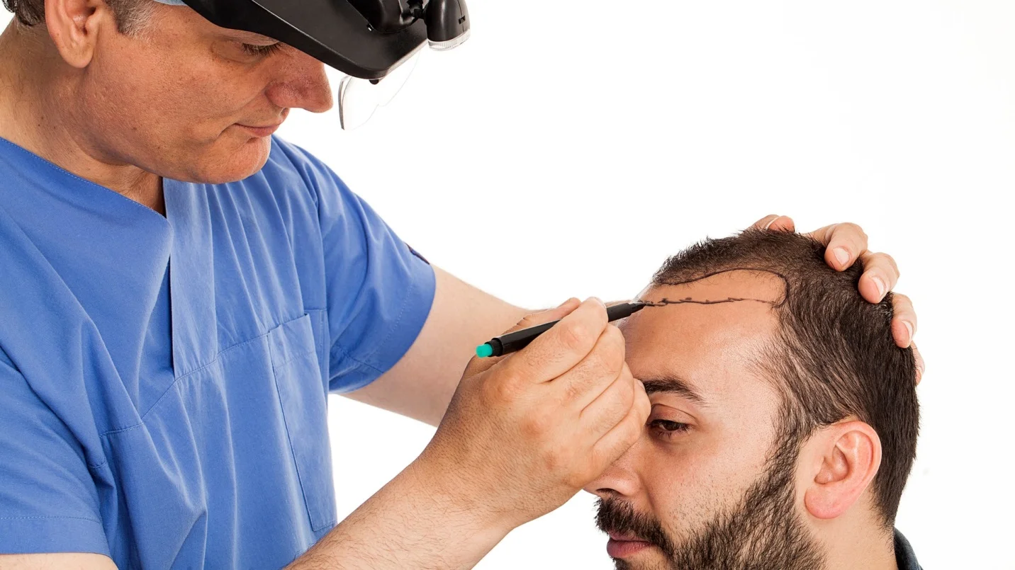  What Type of Hair Transplant is Best For You?